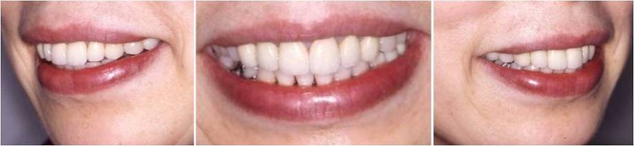 矯正歯科の症例