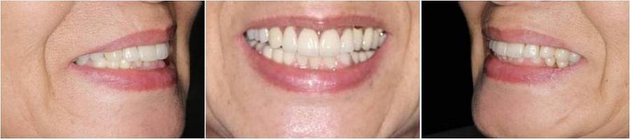 アンチエイジング歯科の症例