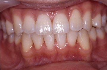 歯並び・咬み合わせの症例