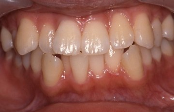 歯並び・咬み合わせの症例