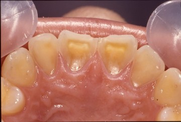 歯の裏側